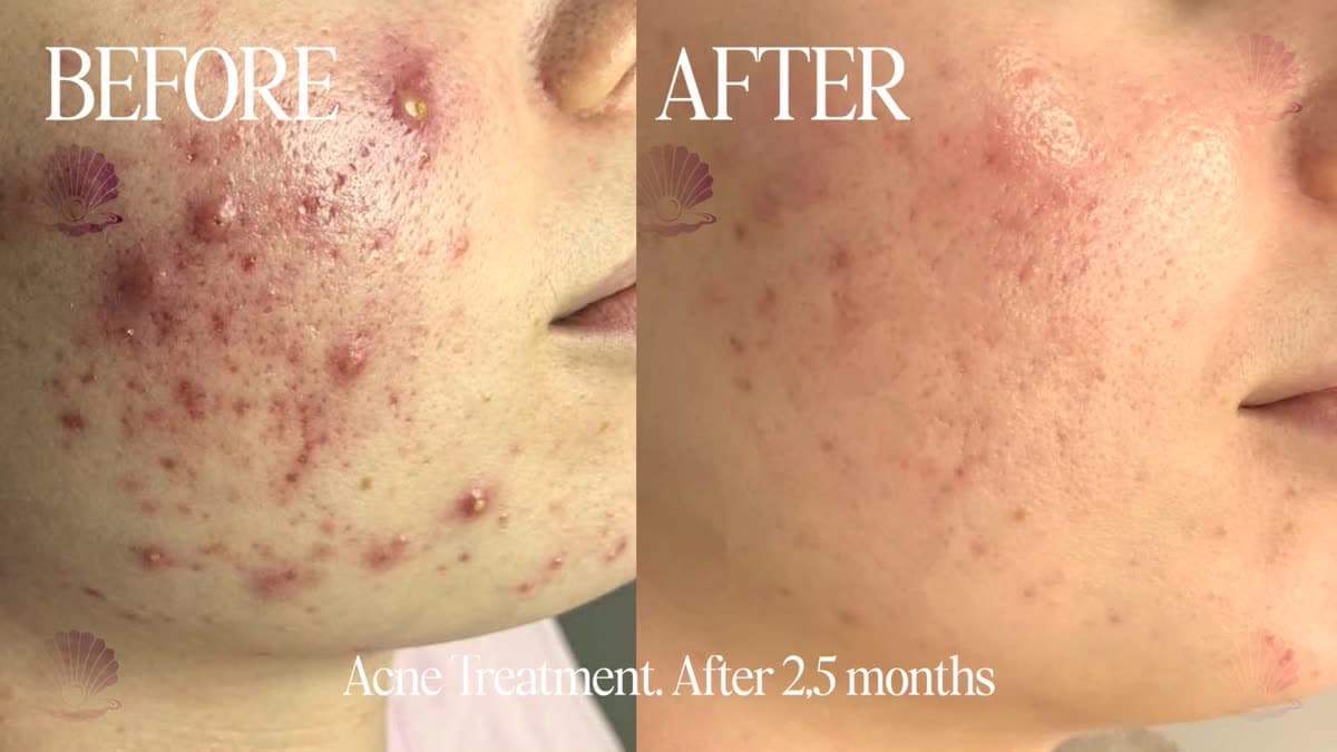 Active breakouts