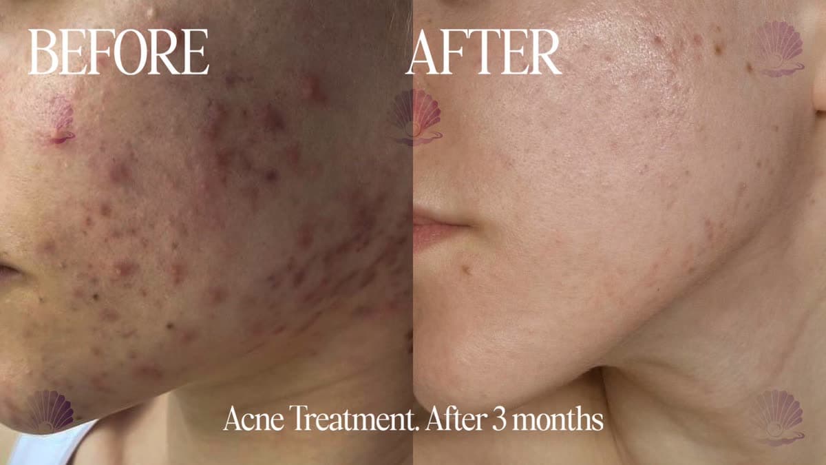 Oily, congested skin