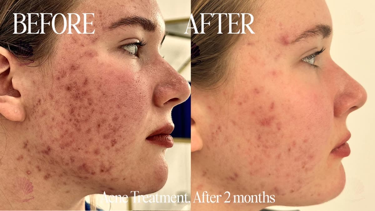 Acne-prone skin