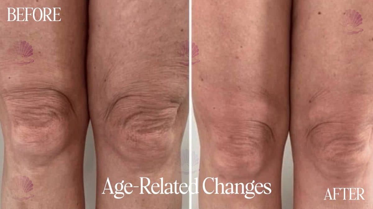 Knees — crepey skin reduced