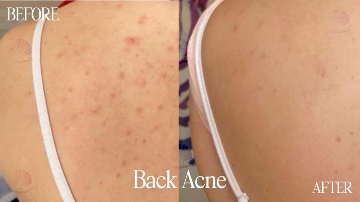 Back — acne cleared