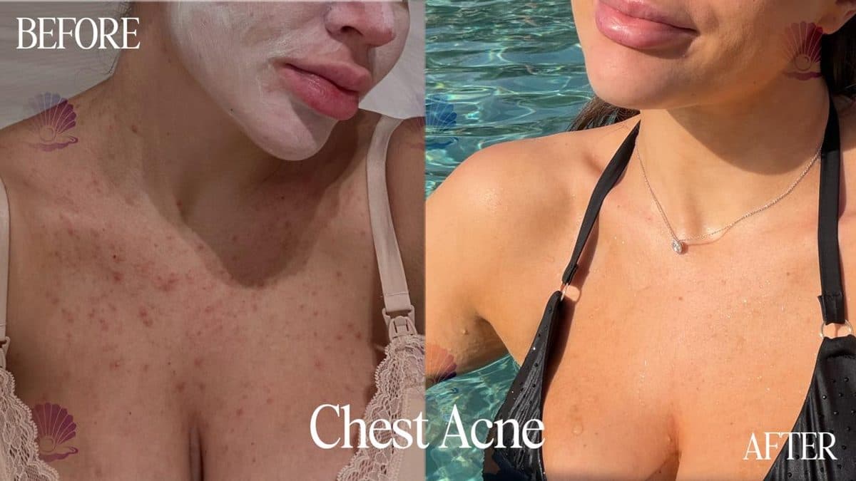 Chest — acne cleared