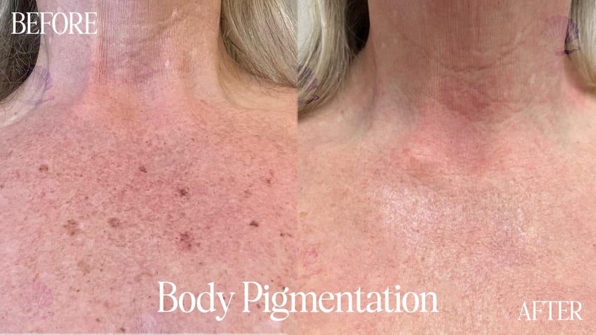 Décolleté — pigmentation