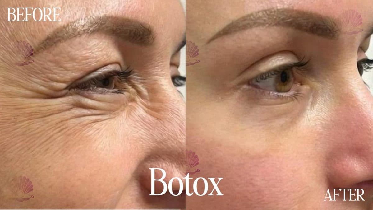 Eye — crow's feet reduced