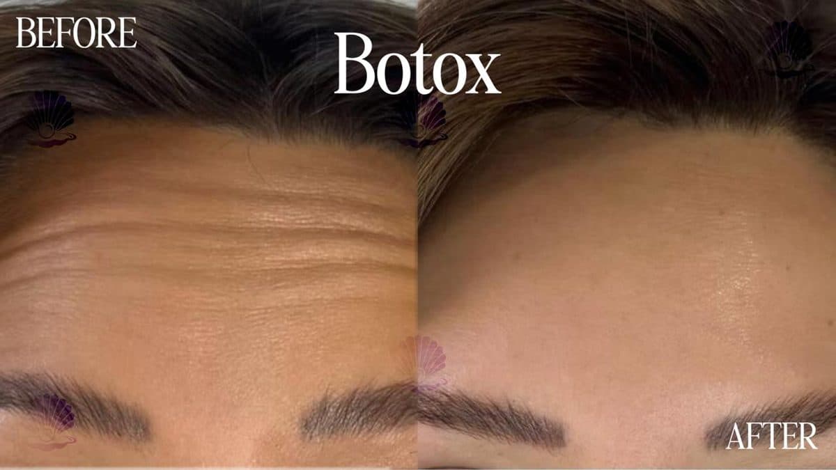Forehead — lines smoothed
