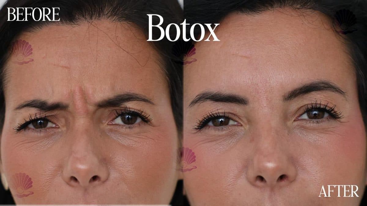 Face — upper face relaxed