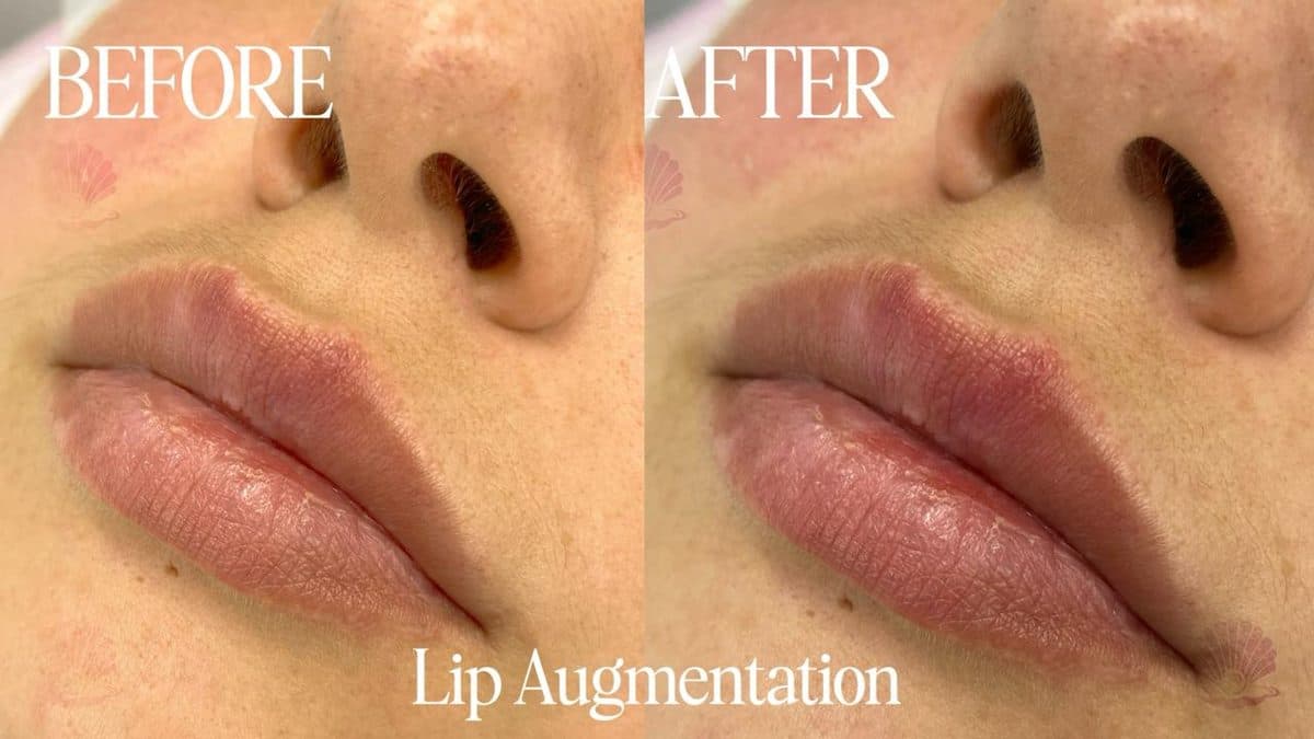 Lips — shape & definition