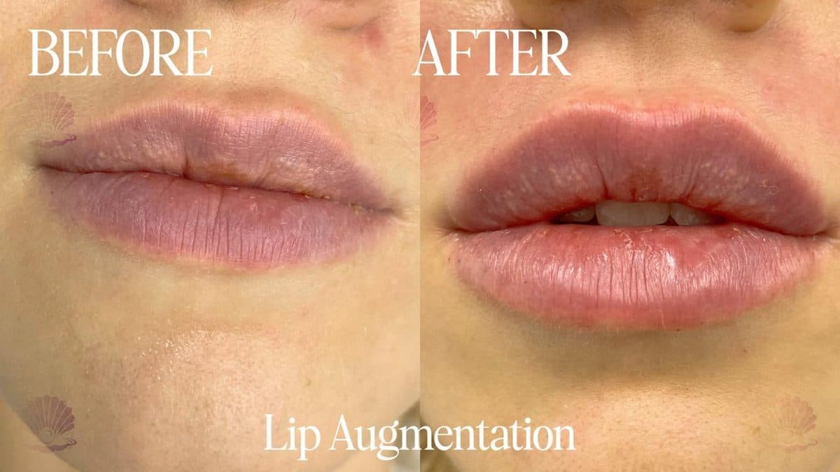 Lips — volume & proportion