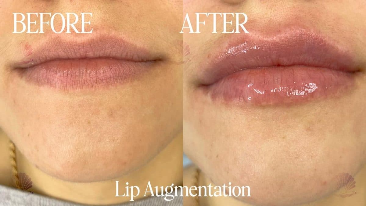 Lips — immediate result