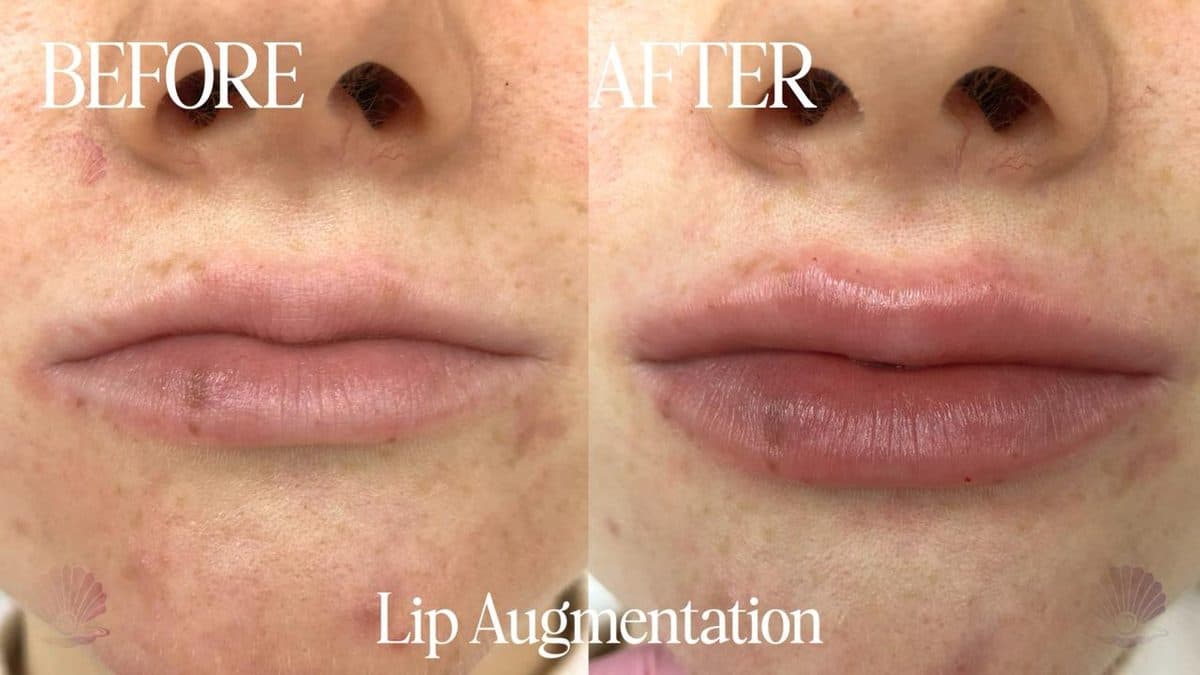 Lips — natural fullness