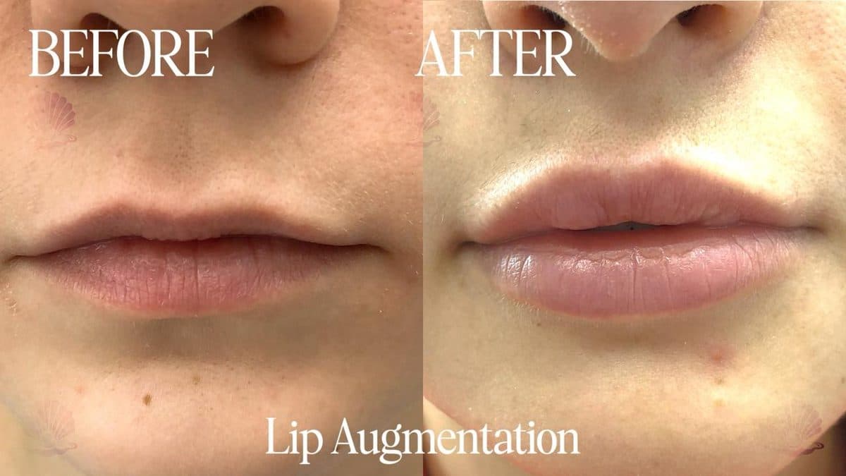 Lips — subtle enhancement