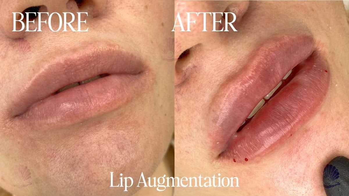 Lips — improved shape