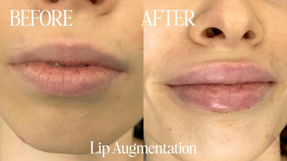 Lips — fuller profile