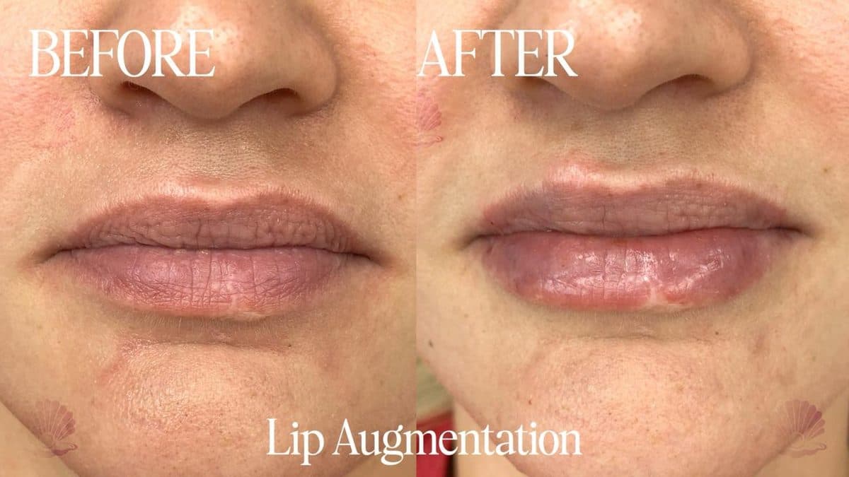 Lips — natural enhancement