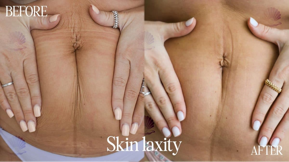Abdomen — skin tightening