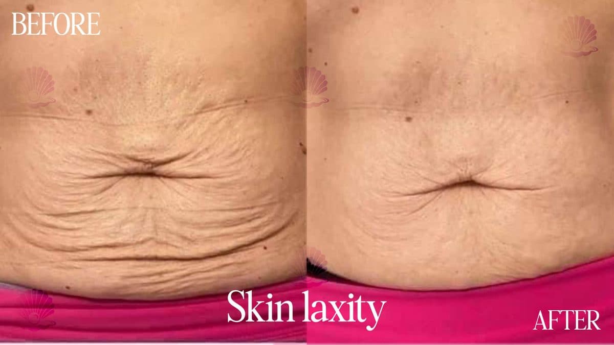 Abdomen — loose skin reduced