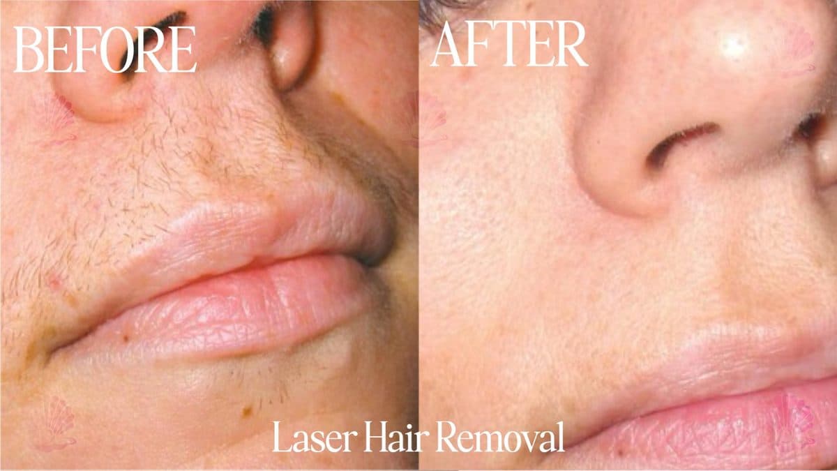 Upper lip — ingrowns cleared