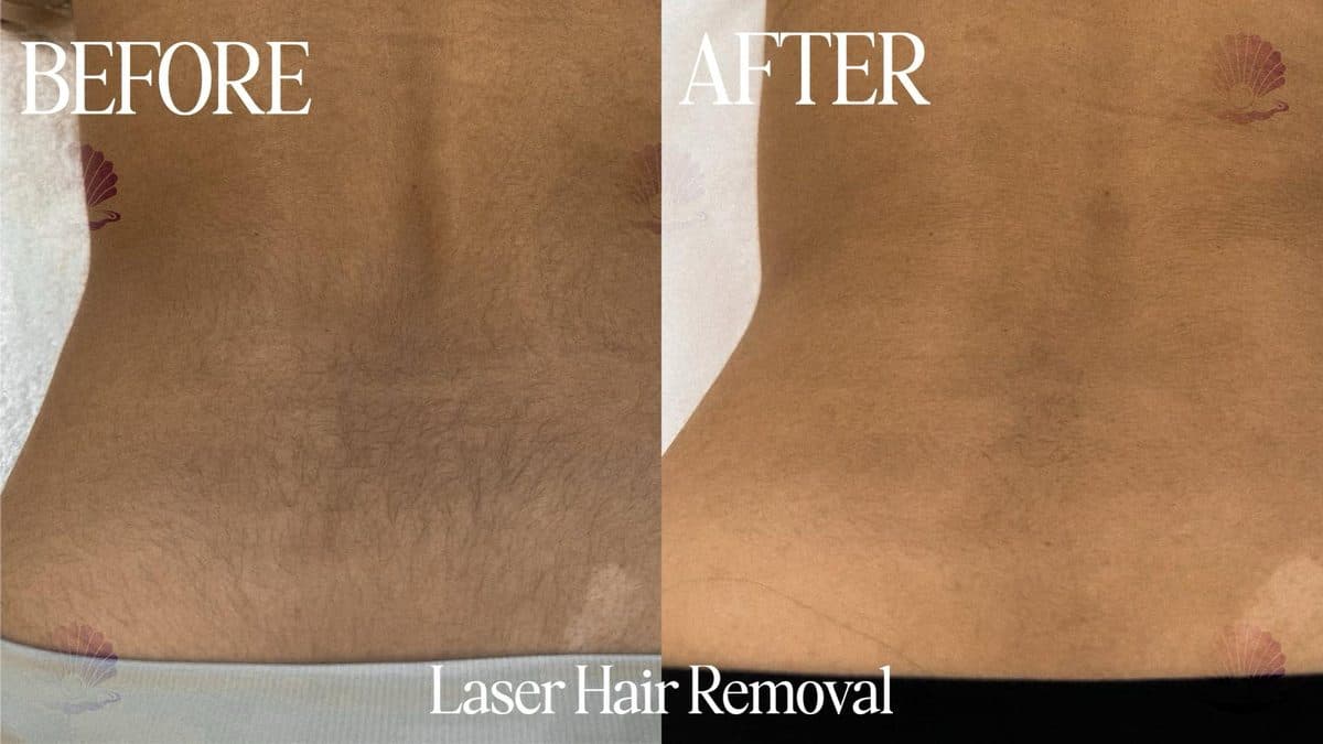 Lower back — hair & ingrowns reduced