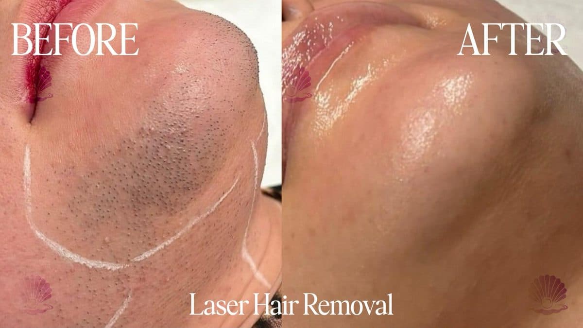 Chin — ingrown follicles
