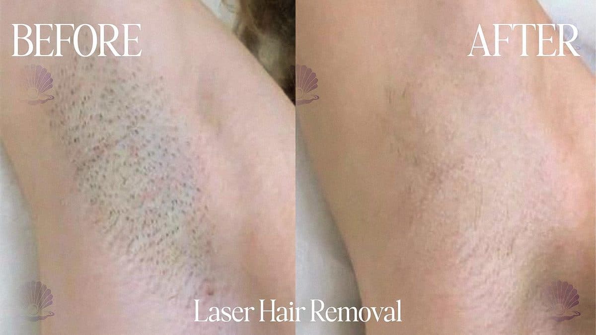 Underarm — ingrowns & marks