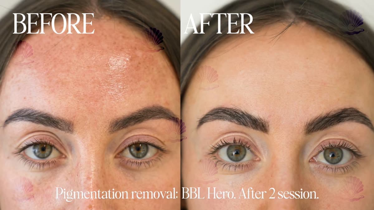 Melasma