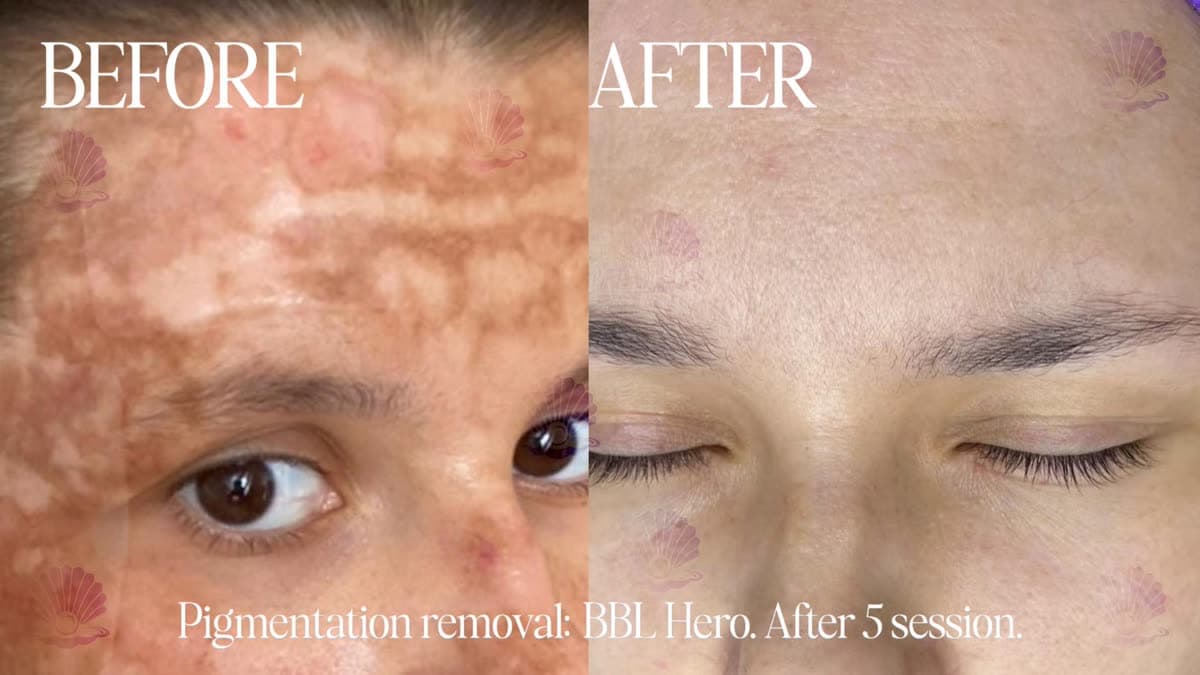 Sun spots and age spots
