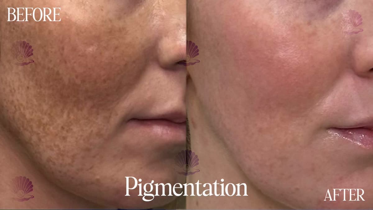 Uneven skin tone