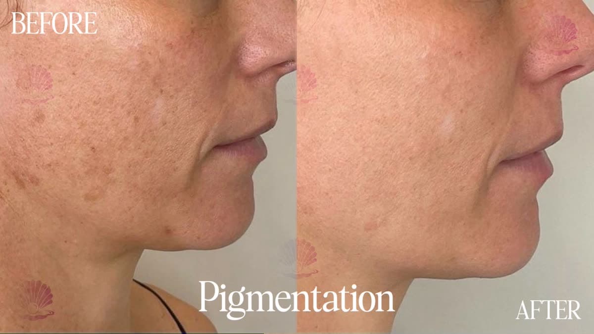 Photoaging-related pigmentation