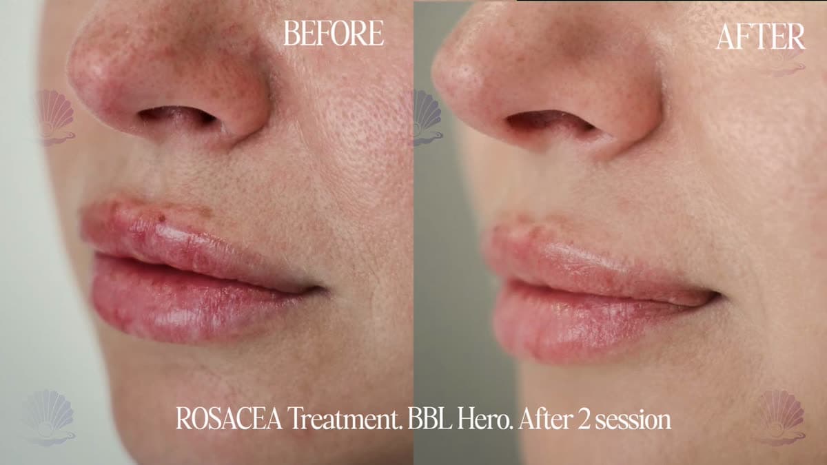 Rosacea