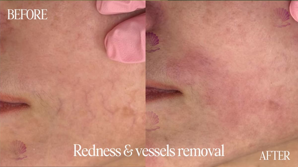 Couperose and visible capillaries