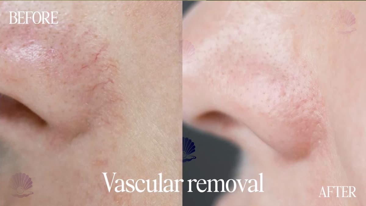 Broken capillaries