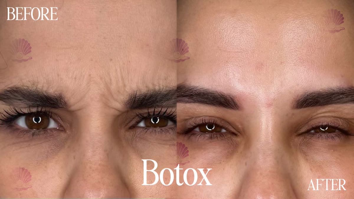 Loss of skin elasticity