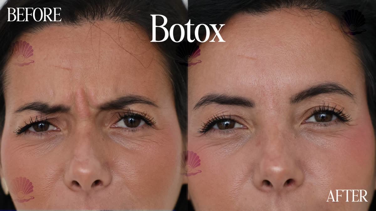 Under-eye ageing and fatigue