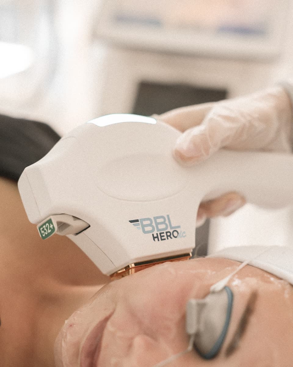 BBL phototherapy