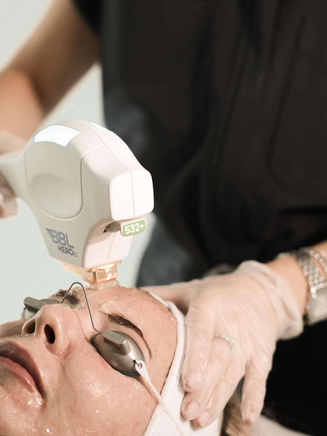 Hyperpigmentation treatment approach at Pearl Skin Polyclinic