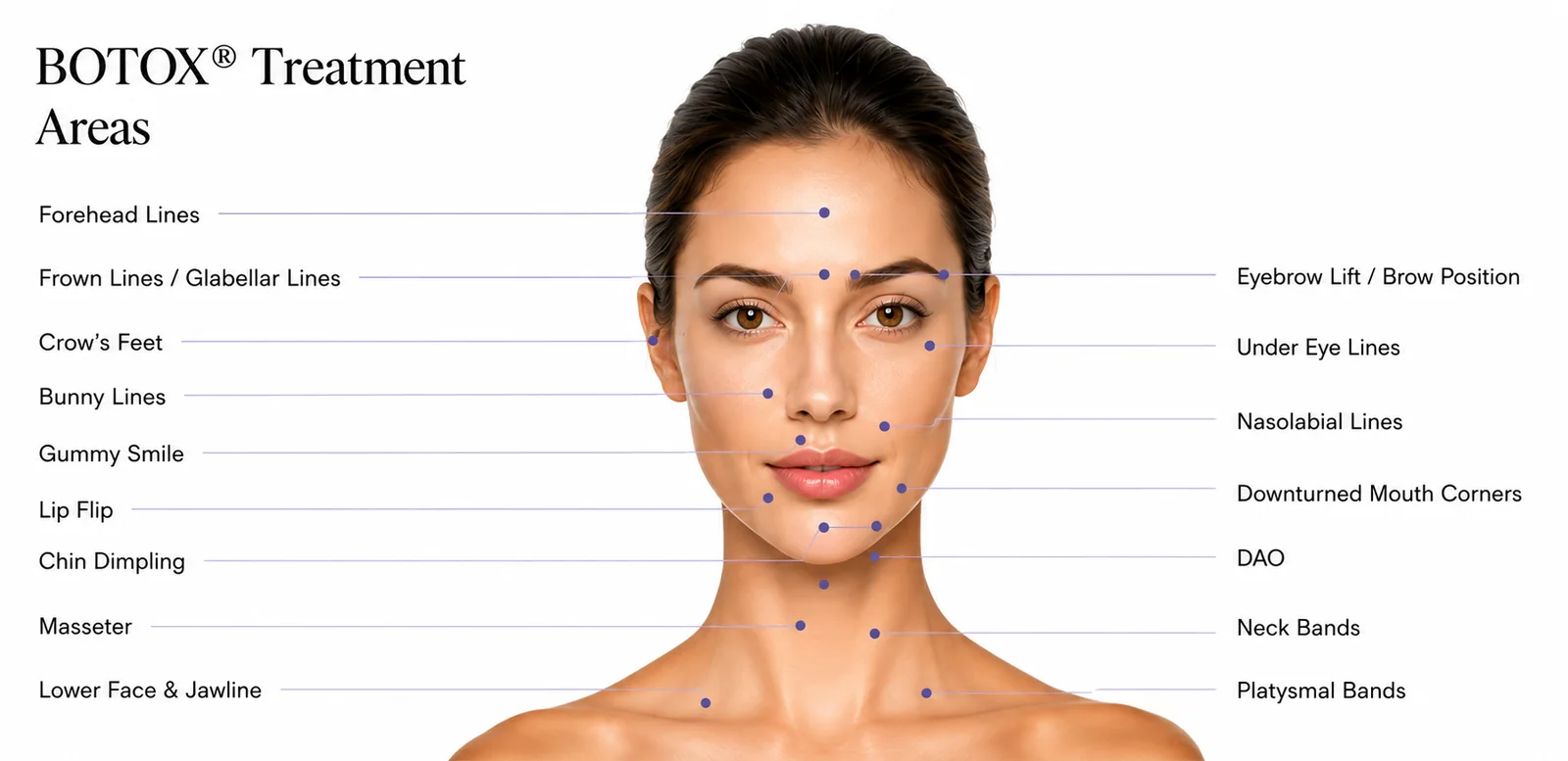 BOTOX treatment areas: sites labelled on leader lines around a face and neck