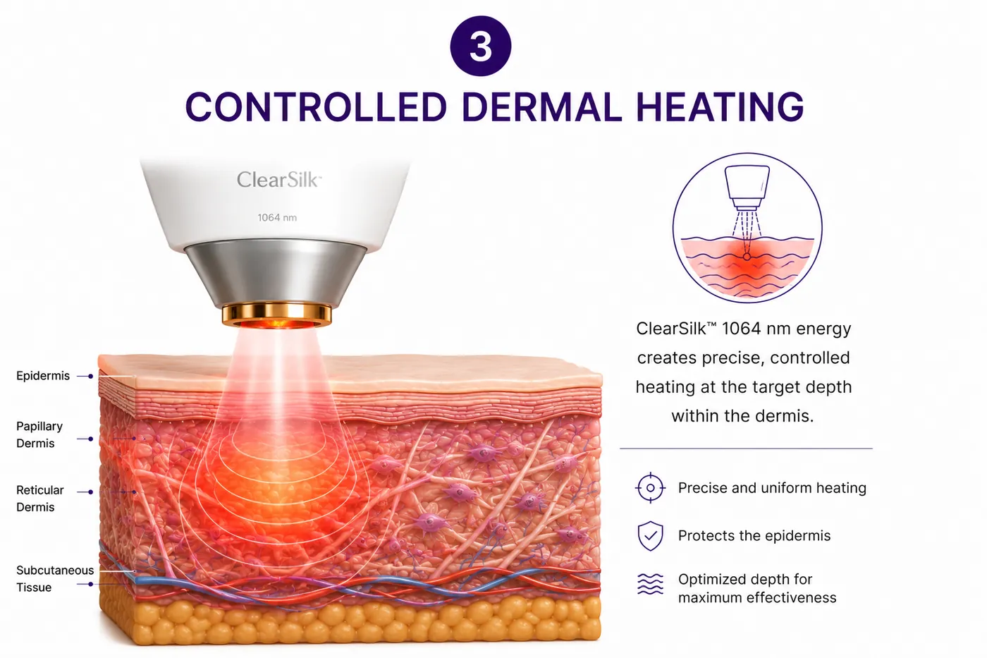 Step three, controlled heating shown at depth through the labelled skin layers