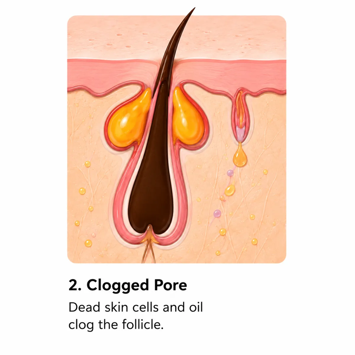 A follicle clogged with dead skin cells and oil