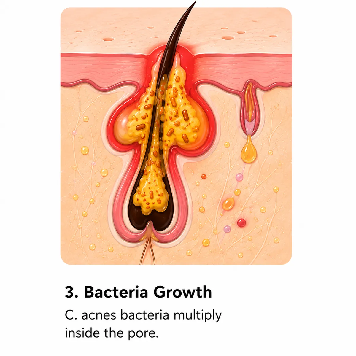 Bacteria multiplying inside a blocked pore