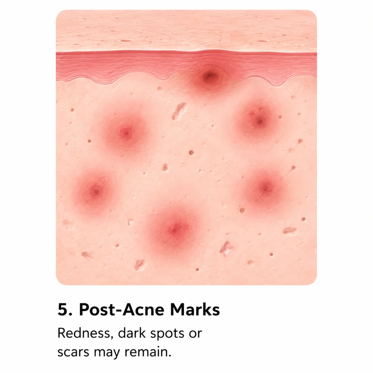 Skin left with post-acne marks