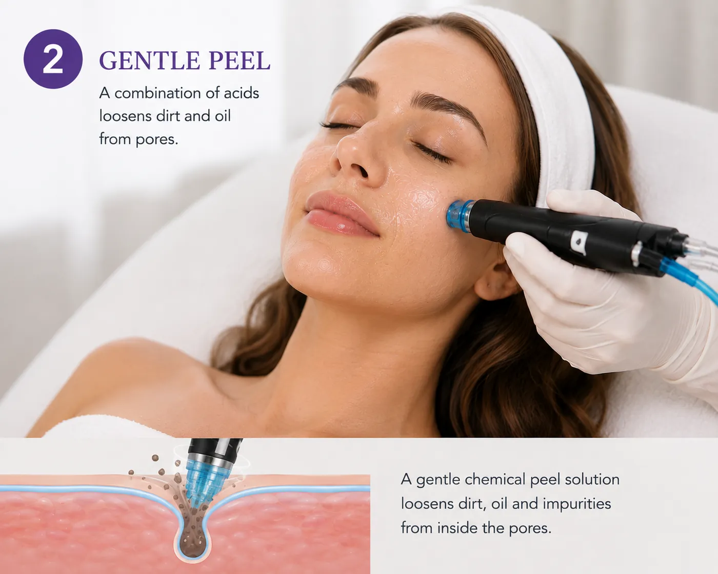 Step two, a peel solution loosening debris inside the pores